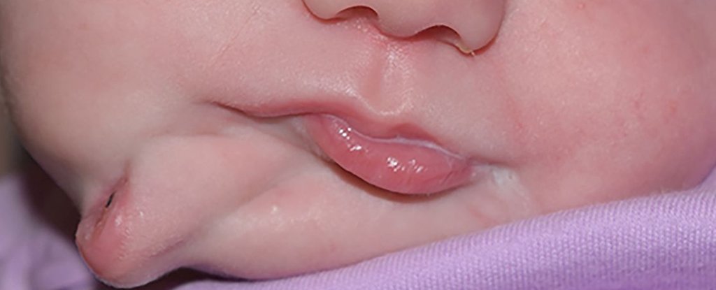 2つの口を持って誕生した赤ん坊の珍しい症例