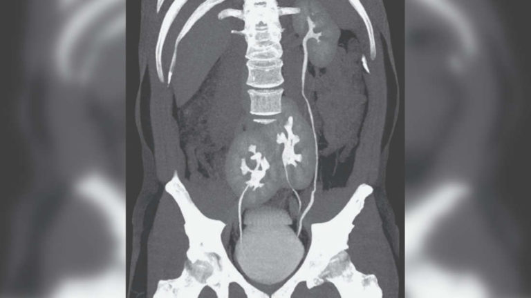 腰痛を訴えた患者、検査の結果腎臓が3つ発見される