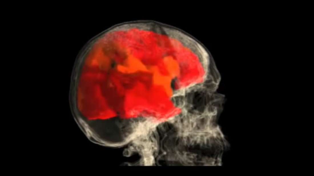 5人の女性がMRI装置内で自慰行為をし、オーガズムに達している時の脳を撮影
